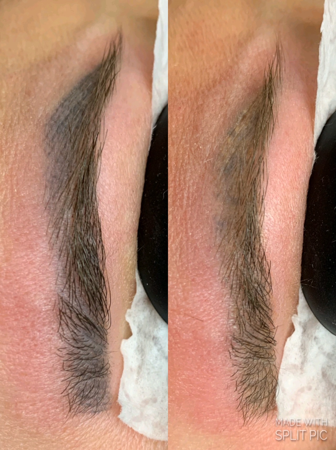 Resultado de remoção a laser